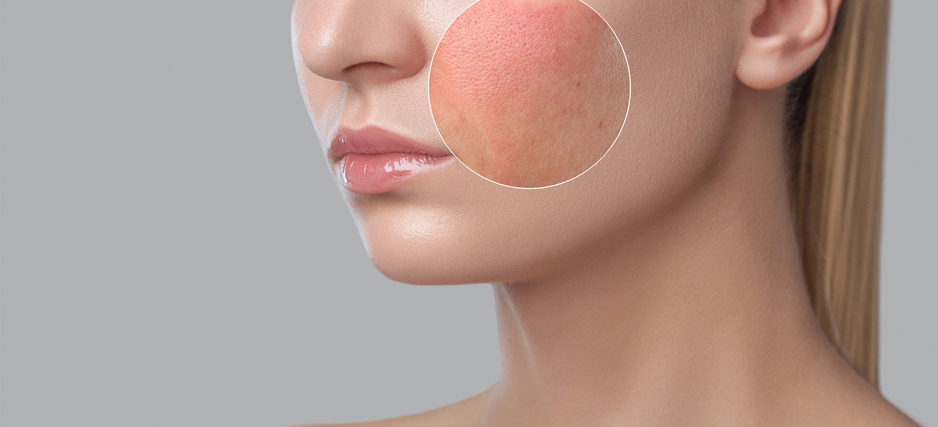 Blotchy facial rash